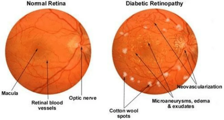 Difference-between-Normal-Retina-and-Diabetic-Retinopathy