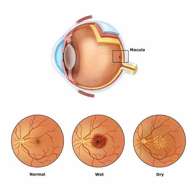 macular-degeneration-wet-dry